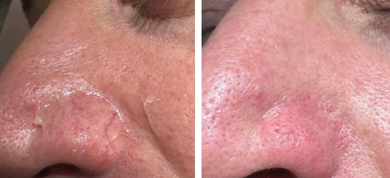 Лазерная эпиляция