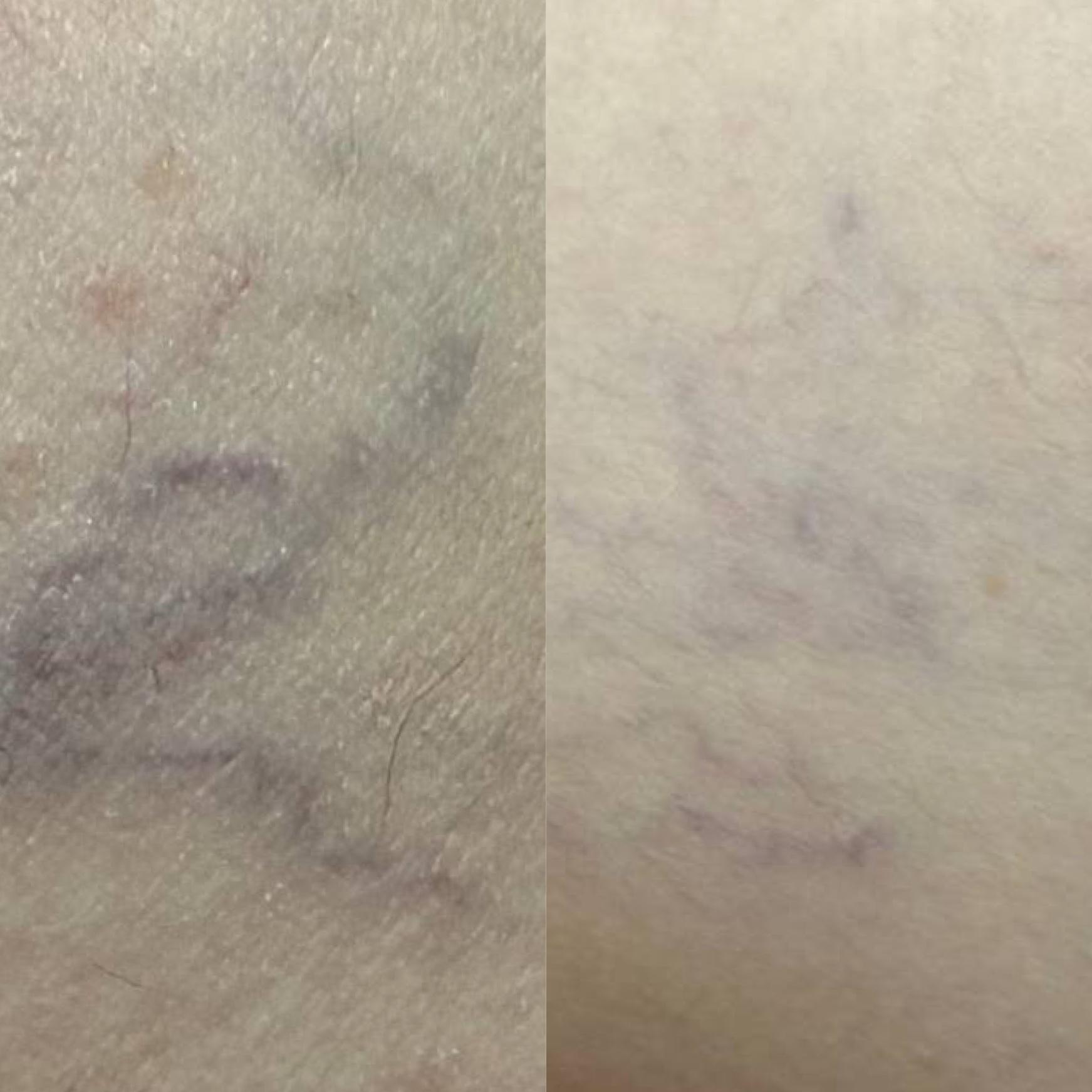 Лазерная эпиляция