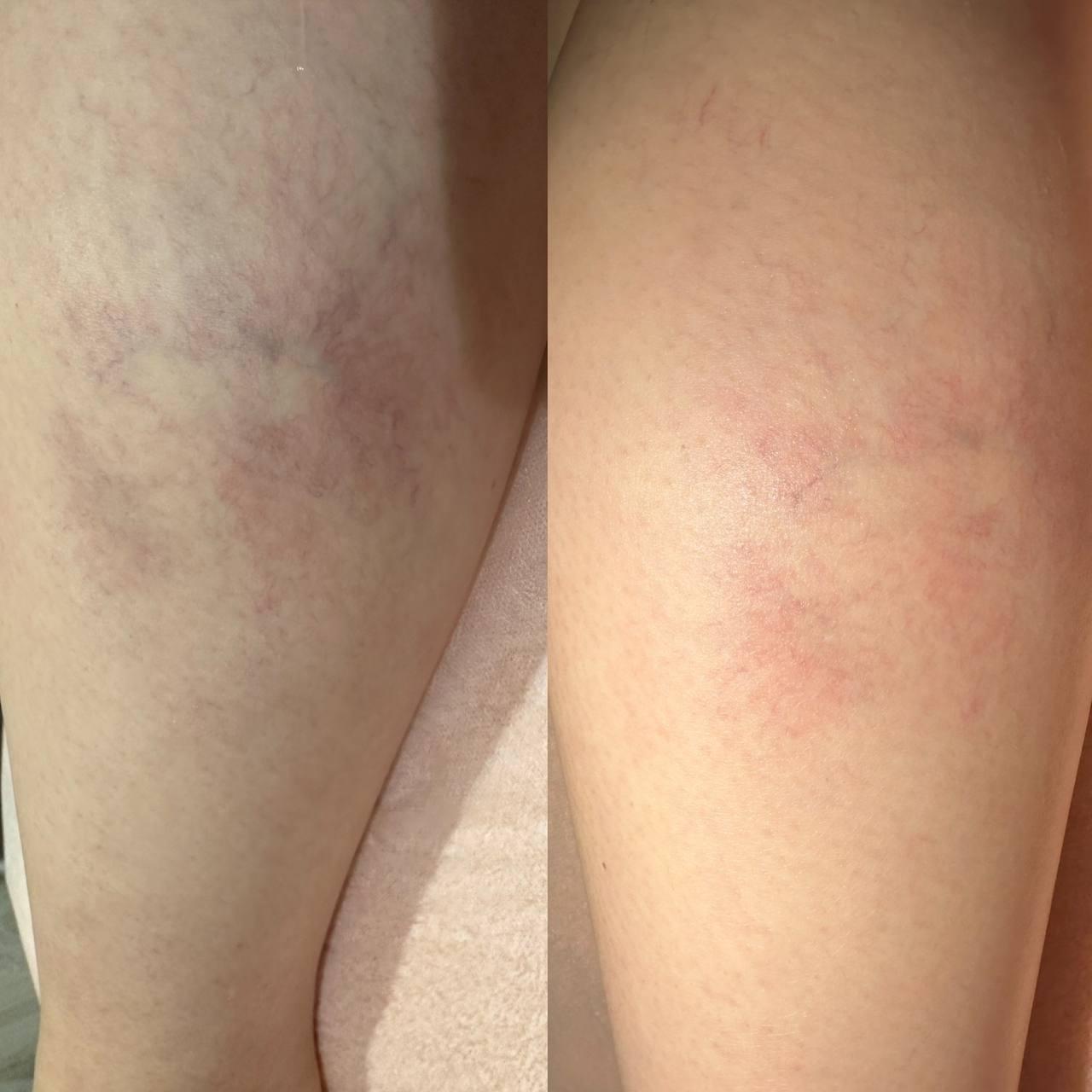 Лазерная эпиляция